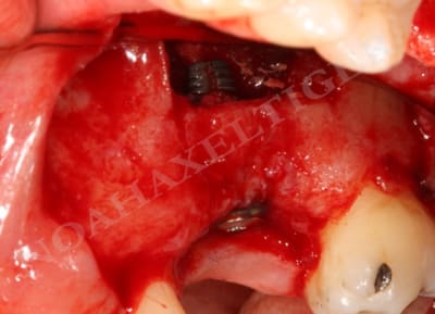 Mise en place de l implant vhizmd - Eugenol