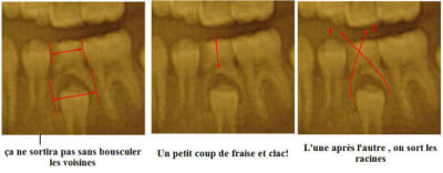 Molaire de lait tojutr - Eugenol
