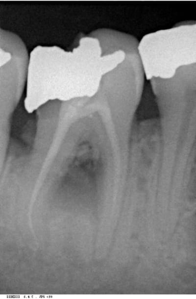 Necrose 2 qoc5nn - Eugenol