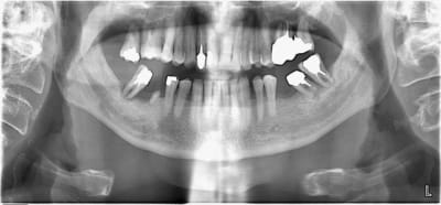 Nerf bifide v8e4kc - Eugenol