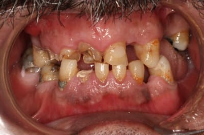 Occlusion pr  op cgna2r - Eugenol