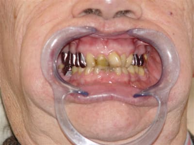 Occlusion début de traitement sqqcrw - Eugenol