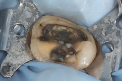 Onlay079 yt1tbf - Eugenol