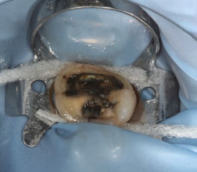 Onlay081 ywie1b - Eugenol