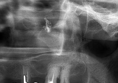 Opt cal agrandissement tzf0rv - Eugenol