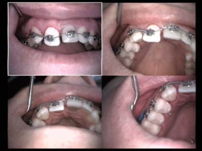 Ortho juin 2004 b3esif - Eugenol