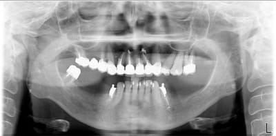 Pano dentisterie holistique athplu - Eugenol