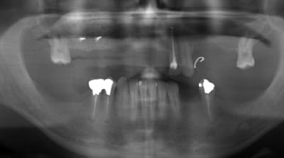 Pano post op q9hcss - Eugenol