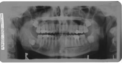 Panorex dfj krx0yo - Eugenol