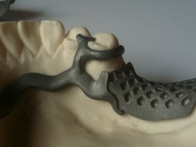 Partiel amovible titane fhexie - Eugenol