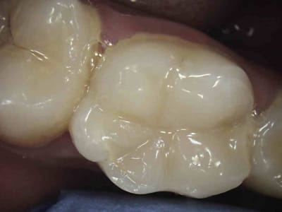 Pas de couronne chiotte   aibhmx - Eugenol