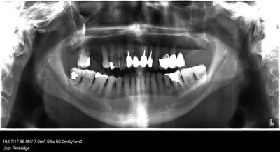 Patient 2017 e4rfhy - Eugenol