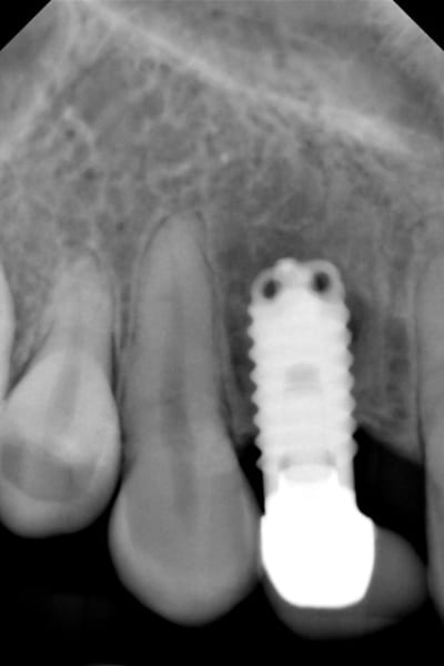 Patiente edqvmk - Eugenol