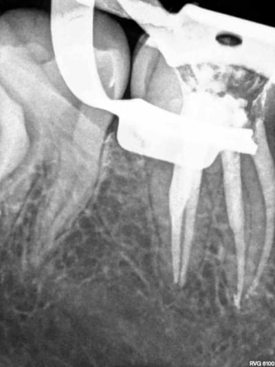 Perfo distale  vive le clamp   ujwqa0 - Eugenol