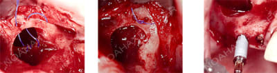 Perforation sutur e eqqne3 - Eugenol