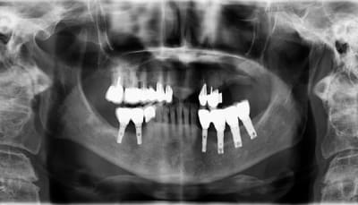 Peri implantite mmkxxm - Eugenol