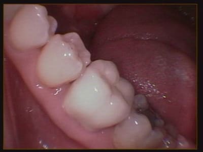 Photo cas terminé l2nhxs - Eugenol