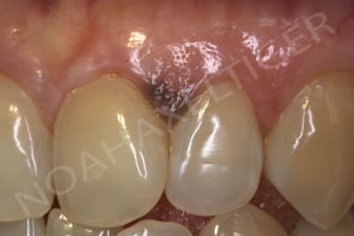 Pigmentation gingivale lbwybo - Eugenol