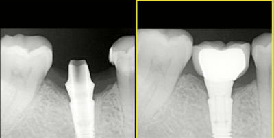 Pilier sur implant osseospeed nmnbyz - Eugenol