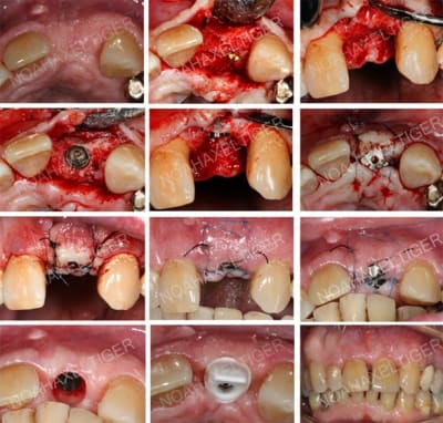 Planche implant apres greffe onlay   conjonctif   atlantis   alumina u6itam - Eugenol