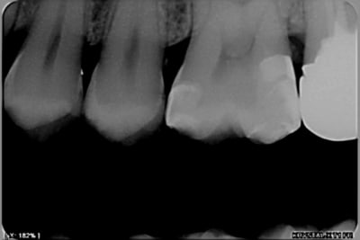 Post op 1 copy a3l6hs - Eugenol