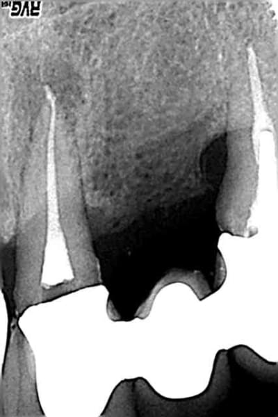 Post op d21 le 17 01 05 km0apu - Eugenol
