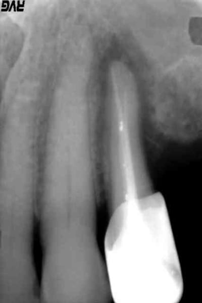 Post op ikznwc - Eugenol