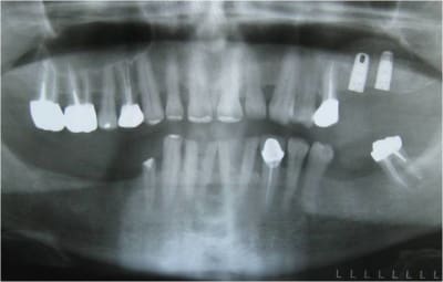 Post op pnpnov - Eugenol