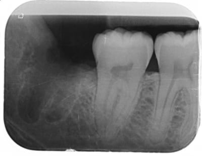 Post op qhracp - Eugenol