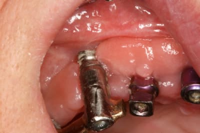 Pr  op  implants 002 mmejxs - Eugenol