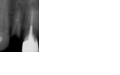 Pre op avril 08 bhvr02 - Eugenol