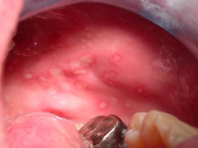 Primoinfection herpes 1 yezrfn - Eugenol