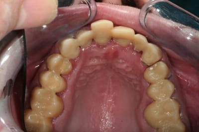 Provisoires occlusal qccrqk - Eugenol