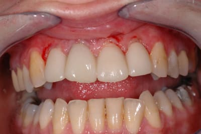 Provisoires un2rxi - Eugenol