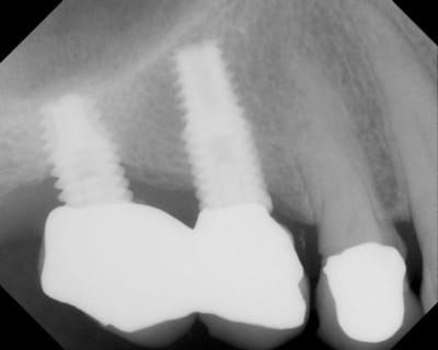 Quel implant h0t7zq - Eugenol