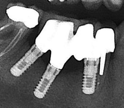 Quels implants nvjd1v - Eugenol