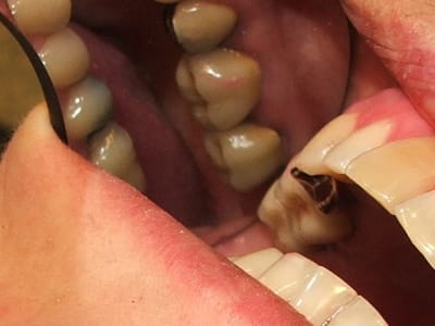 Récession vwcusm - Eugenol