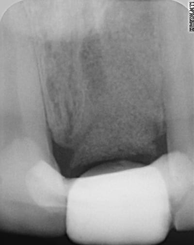 Radio post op guwx4p - Eugenol