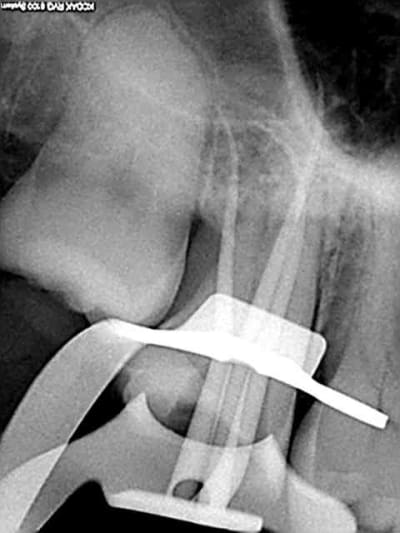 Radios cones en place  lcmqtr - Eugenol
