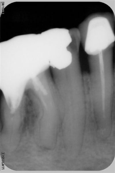 Reprise avant instrument fractur  lwjzpw - Eugenol