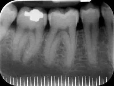 Resorption gytdi2 - Eugenol