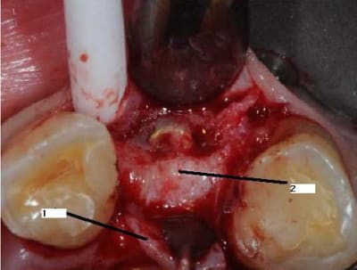 Rouleau dentiste57 x8191y - Eugenol