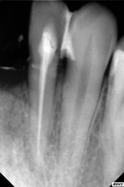 Rx3 sibrsa - Eugenol