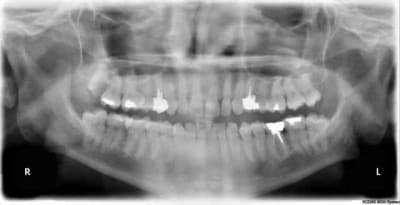 Sagesse sinus qkroz6 - Eugenol