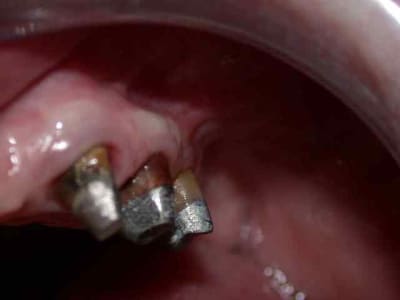 Seceur ii hd2pli - Eugenol