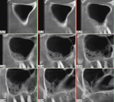 Sinus droit ymrbjj - Eugenol