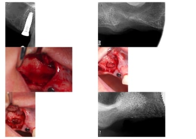 Sinus lift 1 2 u3jxs7 - Eugenol