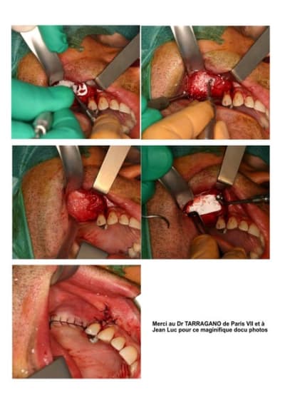 Sinuslift3 k4m3pd - Eugenol