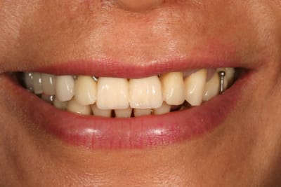 Sourire trop long   gauche qipz0y - Eugenol