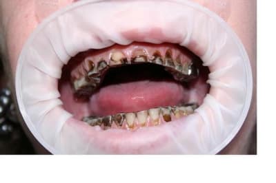 Souriredenfer2 va3bta - Eugenol